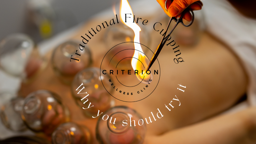Traditional Fire cupping, port Coquitlam, poco, traditional chinese medicine, acupuncture
